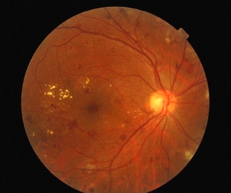 retinal image